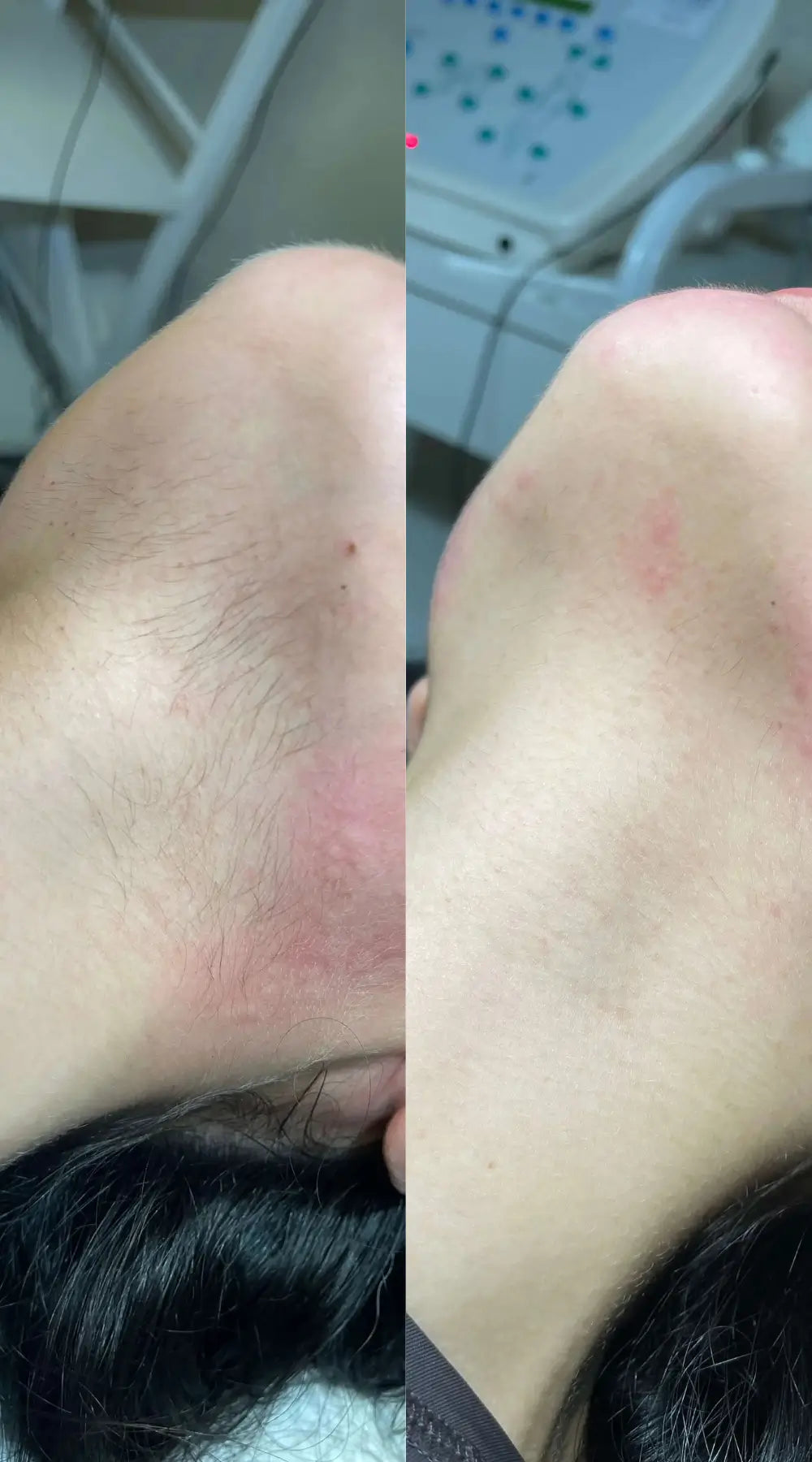 Remove Unwanted Hair with Electrolysis: The Truly Permanent Hair Removal Method